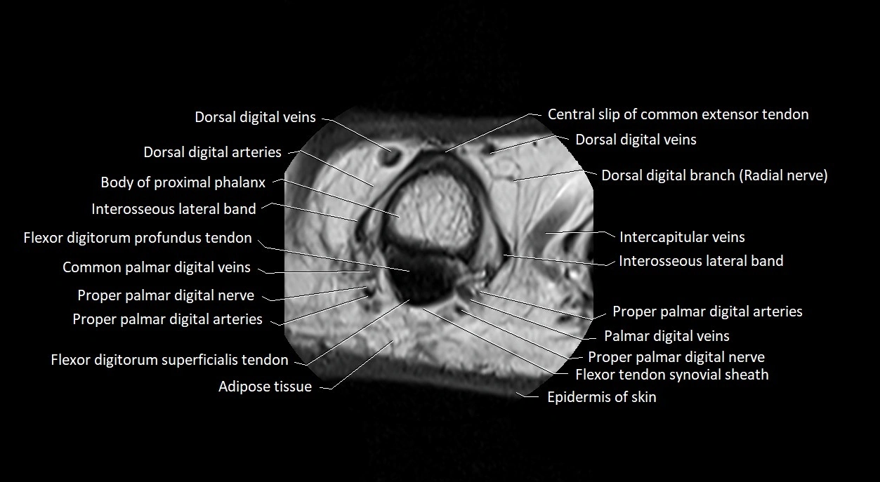 Finger anatomy axial cross sectional 3T image image 20.webp